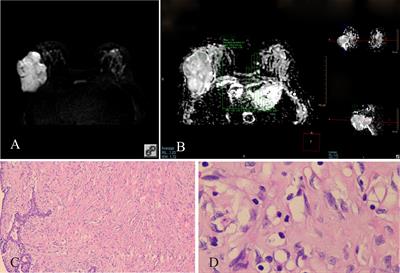 The utility of diffusion-weighted imaging for differentiation of phyllodes tumor from fibroadenoma and breast cancer